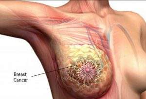 what is Breast cancer